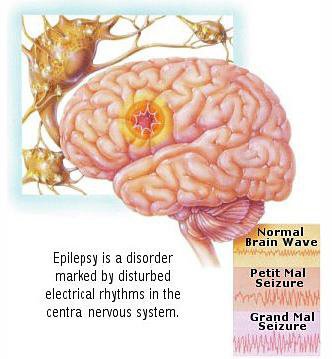 epilepsy disability claim benefits