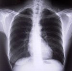 COPD disability insurance benefits claim