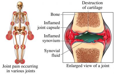 rheumatoid-arthritis-disability-insurance-claim rheumatoid arthritis disability claim