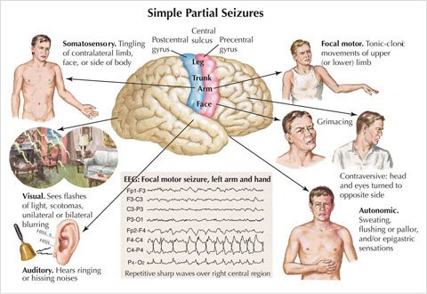 A non-epileptic seizure may resemble a epileptic seizure in outward 