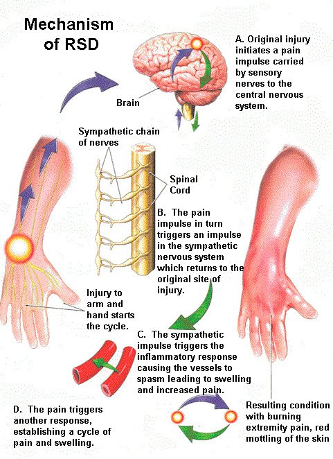 RSd complex regional pain syndrome disability claim