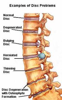 back disorder disability benefits claim