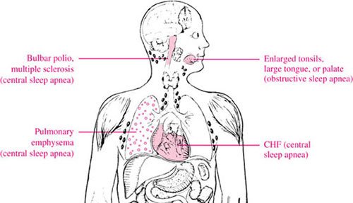 sleep apnea disability benefits claim