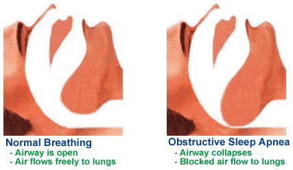 sleep apnea disability claim