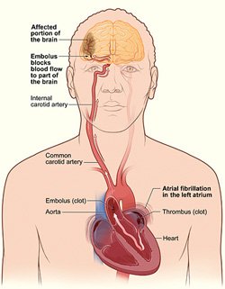 stroke disability insurance claim