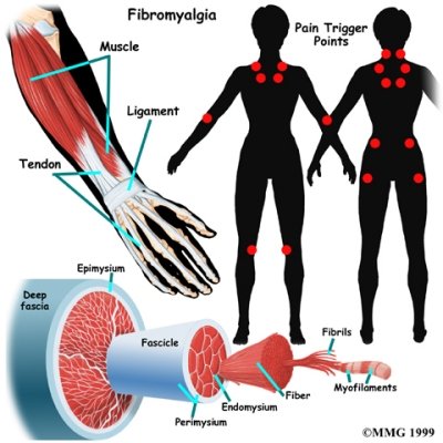 arthritis_fibromyalgia