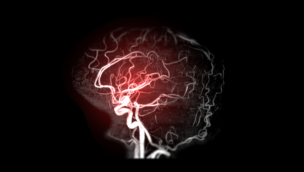 cerebral stroke Prudential disability denial