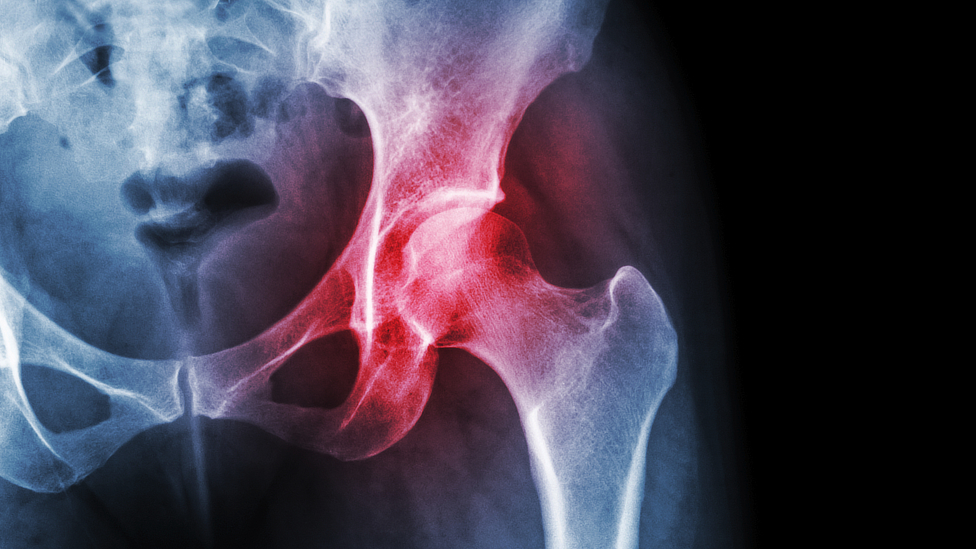 hip pain hartford disability denial