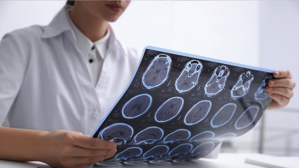 multiple sclerosis disability denial by Unum